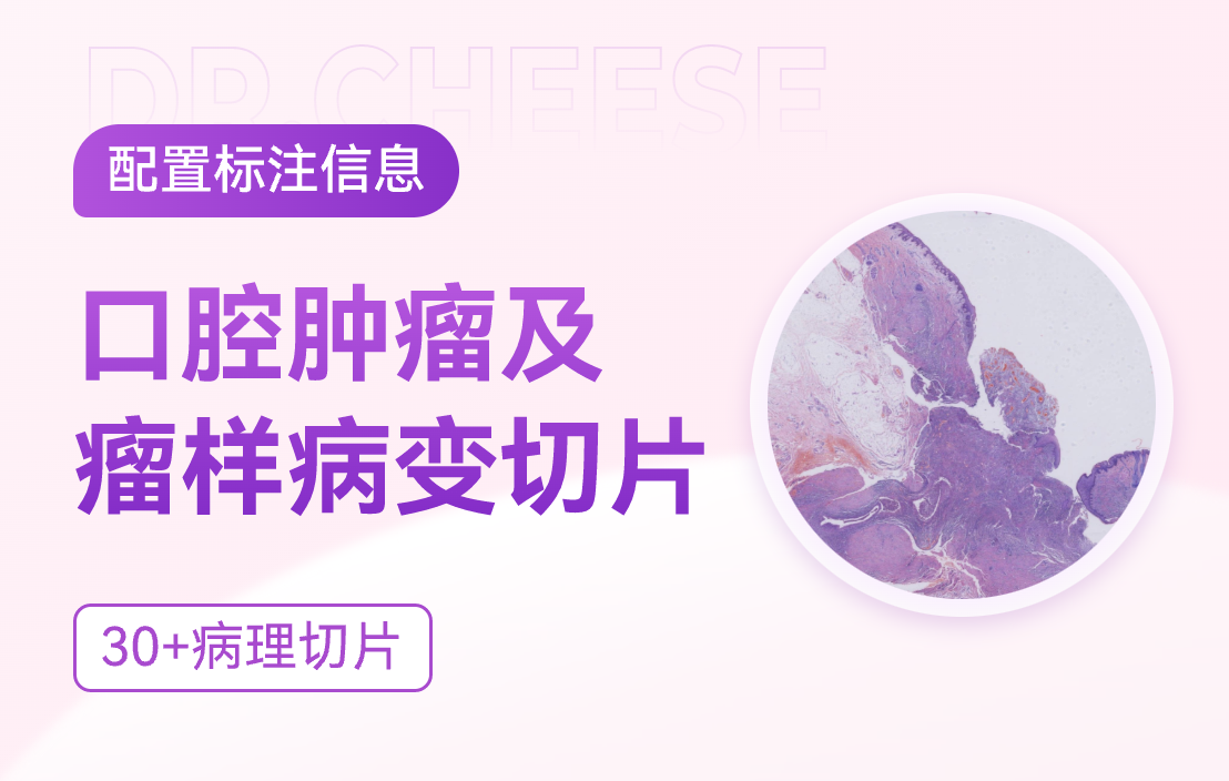 口腔肿瘤切片